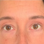 SYLFIRM X Undereye Treatment After
