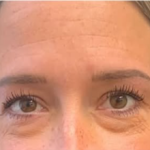 SYLFIRM X Undereye Treatment Before
