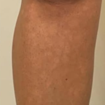 SYLFIRM X Scar Treatment After