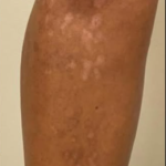 SYLFIRM X Scar Treatment Before