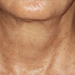 SYLFIRM X Neck Treatment After