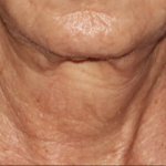 SYLFIRM X Neck Treatment Before