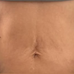 SYLFIRM X Stomach Treatment After