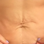 SYLFIRM X Stomach Treatment Before